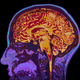 Image for article titled Experimental Alzheimer's Drug Succeeds in Large Trial, but Questions Remain